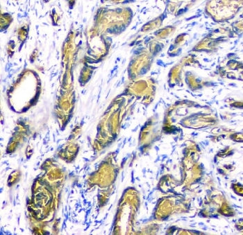 IHC staining of FFPE human prostate cancer tissue with c-Kit antibody. HIER: boil tissue sections in