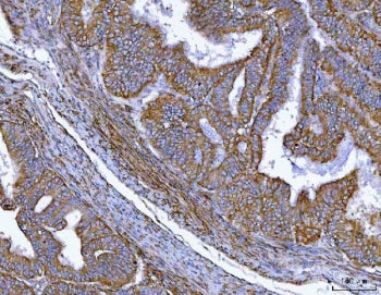 IHC staining of FFPE human endometrial cancer tissue with MTSS1 antibody. HIER: boil tissue sections