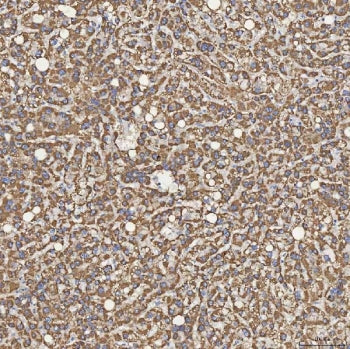 IHC staining of FFPE human liver cancer tissue with Sideroflexin-5 antibody. HIER: boil tissue secti