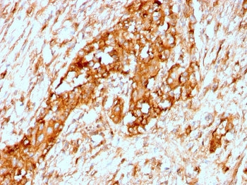 IHC staining of FFPE human breast with recombinant Alpha 1 Antitrypsin antibody (clone AAT/3167R). H