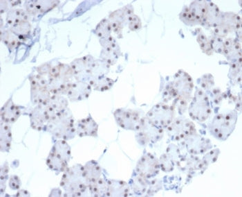 IHC staining of FFPE human renal cell carcinoma tissue with Paired-like homeobox 2B antibody (clone