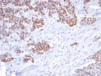 IHC staining of FFPE human serous ovarian carcinoma tissue with recombinant TP53 antibody (clone rTP
