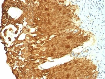 IHC: Formalin-fixed, paraffin-embedded human cervical carcinoma stained with Cytokeratin 19 antibody