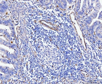 IHC staining of FFPE human gastric adenocarcinoma tissue with CD93 antibody. HIER: boil tissue sections in pH8 EDTA for 20 min and allow to cool before testing.