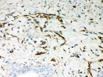 IHC-P: Vimentin antibody testing of human breast cancer tissue. Required HIER: boil tissue sections