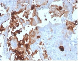 IHC staining of FFPE human breast carcinoma tissue with BPIFB1 antibody (clone LPLUNC1/3206). HIER: