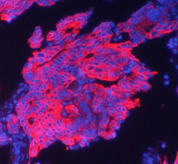 Immunofluorescent staining of human intestinal cancer with Cytokeratin 19 antibody at 1ug/ml. HIER: