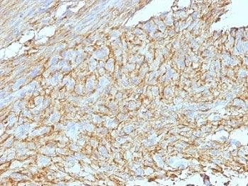 IHC: Formalin-fixed, paraffin-embedded human GIST stained with DOG1 antibody cocktail.