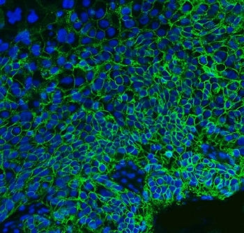 Immunofluorescent staining of FFPE human esophageal squamous carcinoma tissue with Basigin antibody