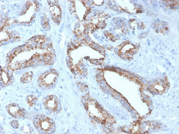 IHC staining of FFPE human prostate carcinoma with recombinant AMACR antibody (clone rAMACR/4674). H