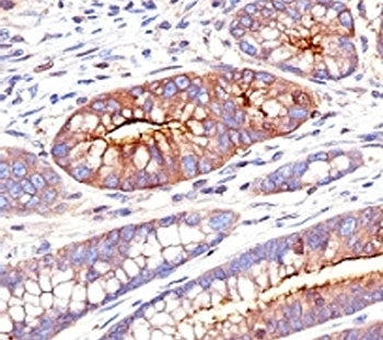 IHC: Formalin-fixed, paraffin-embedded human colon carcinoma stained with CEA antibody (SPM551)