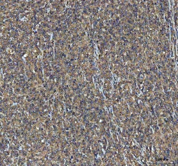 IHC staining of FFPE human large B-cell lymphoma tissue with NEEP21 antibody. HIER: boil tissue sect