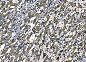 IHC staining of FFPE human liver cancer tissue with Superoxide Dismutase 2 antibody. HIER: boil tiss