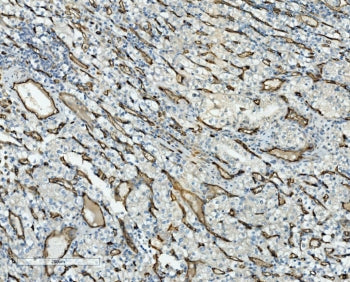 IHC staining of FFPE human glioma with CD34 antibody. HIER: boil tissue sections in pH8 EDTA for 20