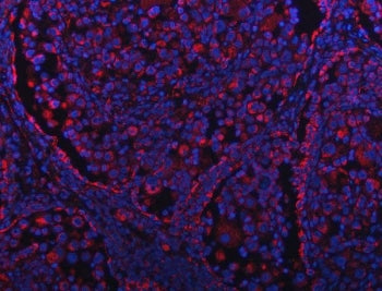 Immunofluorescent staining of FFPE human lung cancer tissue with GRIM19 antibody (red) and DAPI nucl