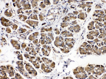 IHC testing of human pancreatic cancer tissue with Alpha Amylase antibody at 0.5ug/ml. Required HIER