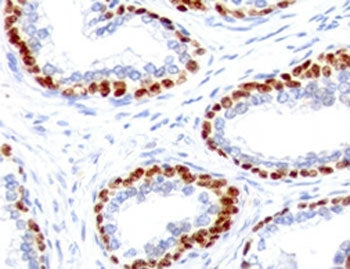 IHC testing of FFPE human prostate cancer with recombinant p63 antibody (clone TMPR63-1R). Required