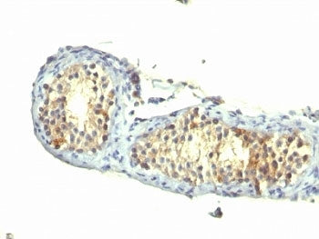 Formalin-fixed, paraffin-embedded human testicular carcinoma stained with TGF-alpha antibody (1E8-G6