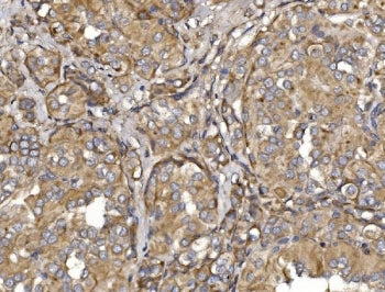 IHC staining of FFPE human thyroid papillary carcinoma tissue with Pyrin antibody. HIER: boil tissue