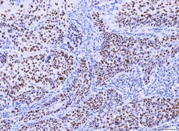 IHC staining of FFPE human laryngeal squamous cell carcinoma tissue with MSH2 antibody. HIER: boil t