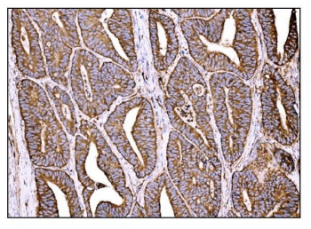 IHC staining of FFPE human rectal cancer tissue with Holocytochrome c-type synthase antibody. HIER: