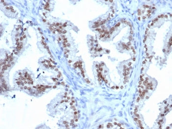 IHC staining of FFPE human prostate tissue with NKX3.1 antibody (clone rNKX3.1/6620). HIER: boil tis