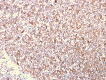 IHC staining of FFPE human lymphoma with LSP1 antibody. HIER: boil tissue sections in pH 9 10mM Tris