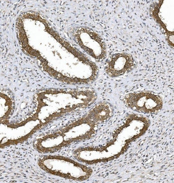 IHC staining of FFPE human breast cancer with PKC theta antibody. HIER: boil tissue sections in pH8