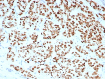 IHC staining of FFPE human breast carcinoma tissue with Estrogen Receptor alpha antibody (clone rESR