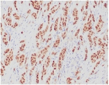 IHC staining of FFPE human breast carcinoma tissue with recombinant ERa antibody (clone ESR1/4039R).