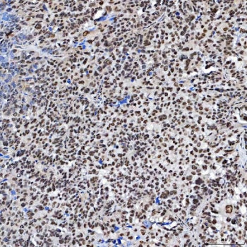 IHC staining of FFPE human ovarian serous cancer tissue with SF3a60 antibody. HIER: boil tissue sect