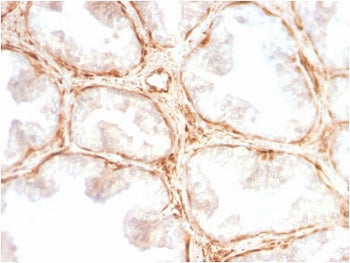 IHC testing of FFPE human prostate carcinoma with recombinant Galectin 1 antibody (clone GAL1/2499R)