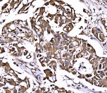 IHC staining of FFPE human breast cancer tissue with PSMD8 antibody. HIER: boil tissue sections in p