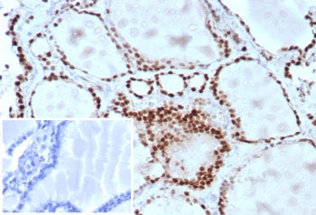 IHC staining of FFPE human lung adenocarcinoma tissue with TTF-1 antibody (clone TTF1/8430). Inset: