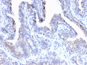 IHC staining of FFPE human prostate cancer tissue with NR5A2 antibody (clone PCRP-NR5A2-1B8). HIER: