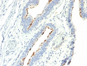 IHC staining of FFPE human colon carcinoma with Thomsen-Friedenreich Antigen antibody (clone A78-G/A