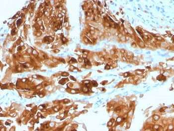 IHC staining of FFPE human urothelial carcinoma with UPK1A antibody (clone UPK1A/2921). HIER: boil t