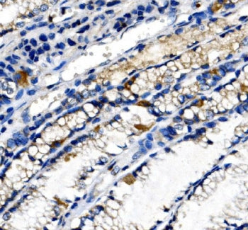 IHC staining of FFPE human gastric cancer tissue with Ghrelin antibody. HIER: boil tissue sections i