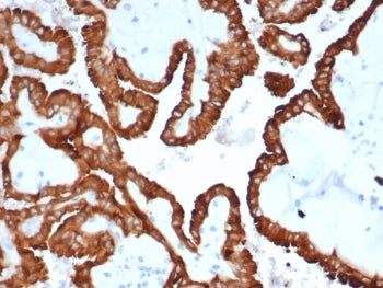 IHC staining of FFPE human kidney cancer with Crystallin Alpha B antibody (clone CRYAB/4665). HIER: