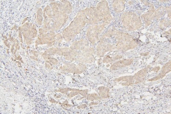 IHC staining of FFPE human breast cancer with Semaphorin 3B antibody. HIER: boil tissue sections in