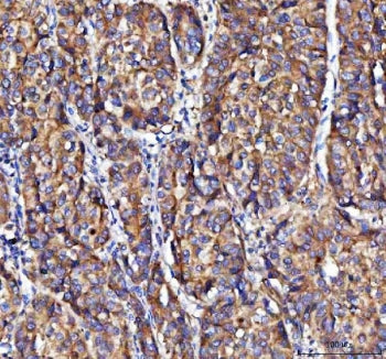 IHC staining of FFPE human liver cancer tissue with Modulator of apoptosis 1 antibody. HIER: boil ti