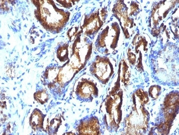 IHC: Formalin-fixed, paraffin-embedded human prostate carcinoma stained with PSA antibody (KLK3/801