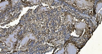 IHC staining of FFPE human renal clear cell carcinoma tissue with MIEF1 antibody. HIER: boil tissue