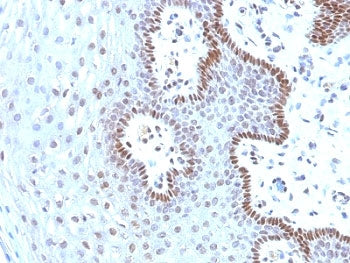 IHC analysis of formalin-fixed, paraffin-embedded human cervical carcinoma stained with c-Myc antibo