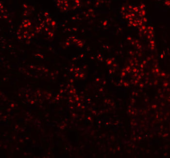 Immunofluorescent staining of FFPE human breast cancer tissue with DIS3 antibody (red). HIER: steam