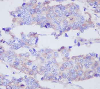 IHC staining of FFPE human breast cancer with MMP2 antibody. HIER: boil tissue sections in pH6, 10mM