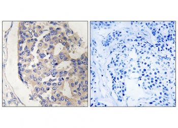 IHC staining of FFPE human breast carcinoma tissue with C1S antibody (left) and without primary anti