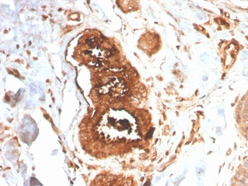 IHC staining of FFPE human breast carcinoma with recombinant Mammaglobin antibody (clone MGB/4058R).