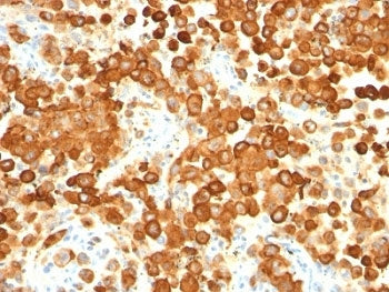 IHC: Formalin-fixed, paraffin-embedded human melanoma stained with gp100 antibody cocktail (HMB45 +