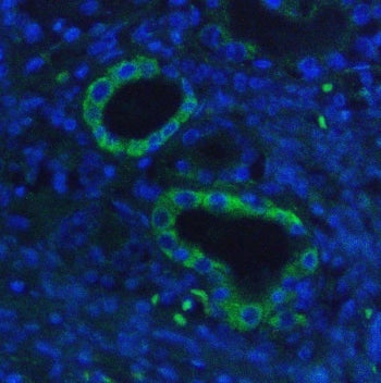Immunofluorescent staining of FFPE human lung cancer with HK1 antibody (green) and DAPI nuclear stai